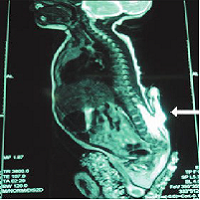 Human Tail in a New Born: A Case Report