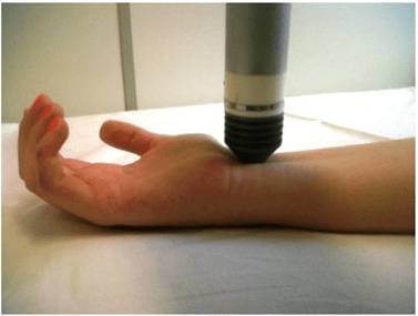 Treatment of the Carpal Tunnel Syndrome with Laser