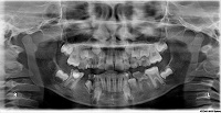 Congenitally Missing Mandibular Second Premolars: A Case Report