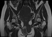 Bilateral Massive Hematoma of Bartholin Glands after Prolonged