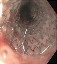 Endoscopic Suturing of Esophageal Stent