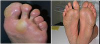 Prevention of Diabetic Foot Ulcers at Primary Care Level