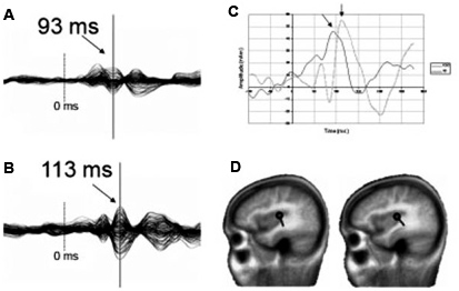Neuroimaging Techniques in Assessment of Auditory Processing Disorders: A Review