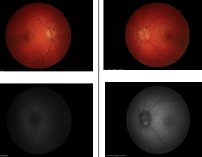 Ocular Health Screening in a Type 1 Diabetes Mellitus Population