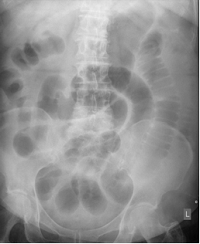 Will Plain Abdominal Radiographs become Obsolete?