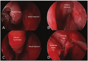 Inferior Turbinoplasty in Children with Nasal