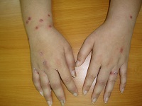 Guttate Psoriasis Can Present With Psoriatic Arthritis